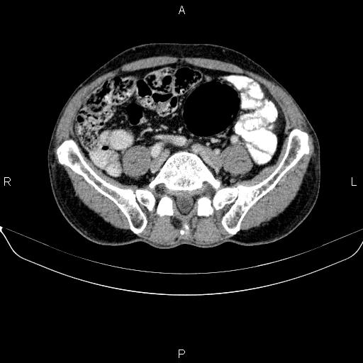 Ampullary adenocarcinoma (Radiopaedia 86093-102032 A 41).jpg