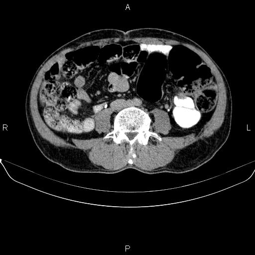Ampullary adenocarcinoma (Radiopaedia 86093-102032 Axial C+ delayed 64).jpg