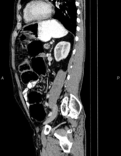 Ampullary adenocarcinoma (Radiopaedia 86093-102032 D 65).jpg