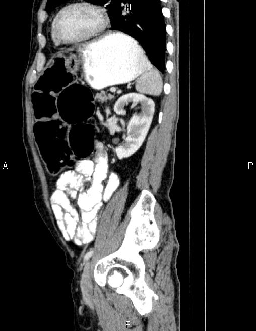 Ampullary adenocarcinoma (Radiopaedia 86093-102032 D 70).jpg