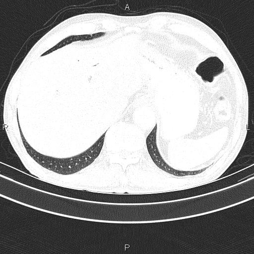 Ampullary adenocarcinoma (Radiopaedia 86093-102033 Axial lung window 50).jpg