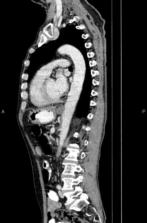 Ampullary adenocarcinoma (Radiopaedia 86093-102033 E 56).jpg