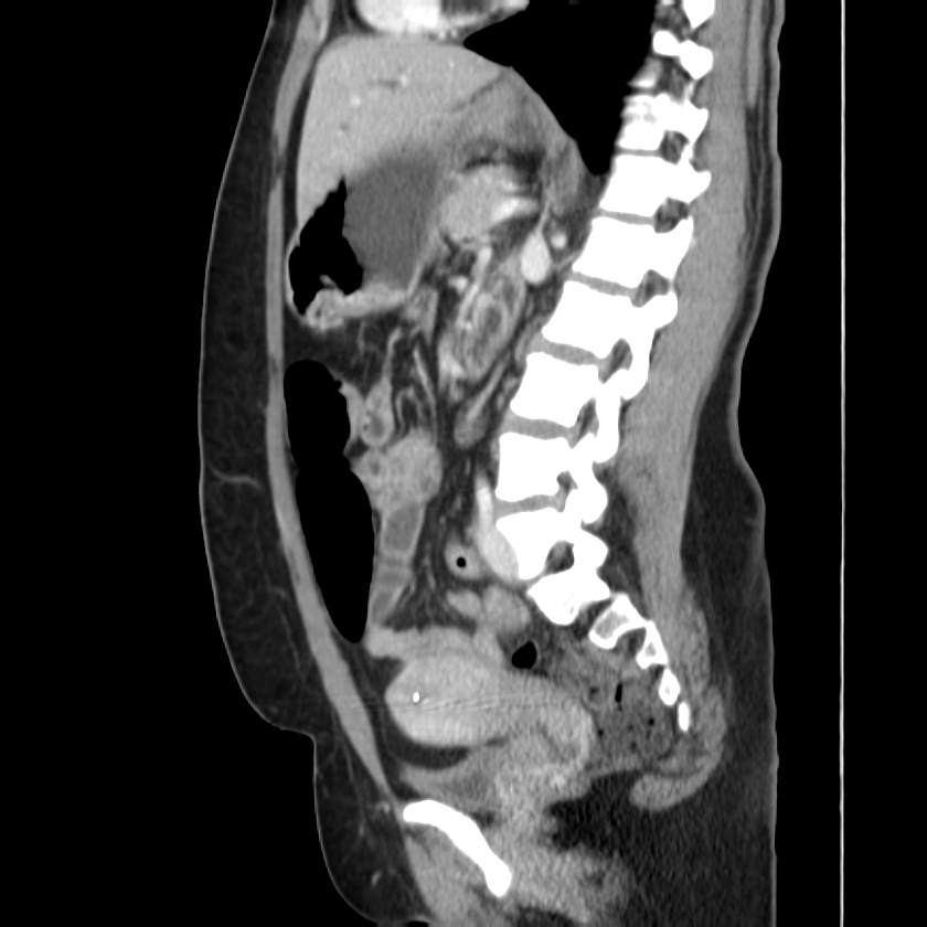 Ampullary tumor (Radiopaedia 22787-22816 D 32).jpg