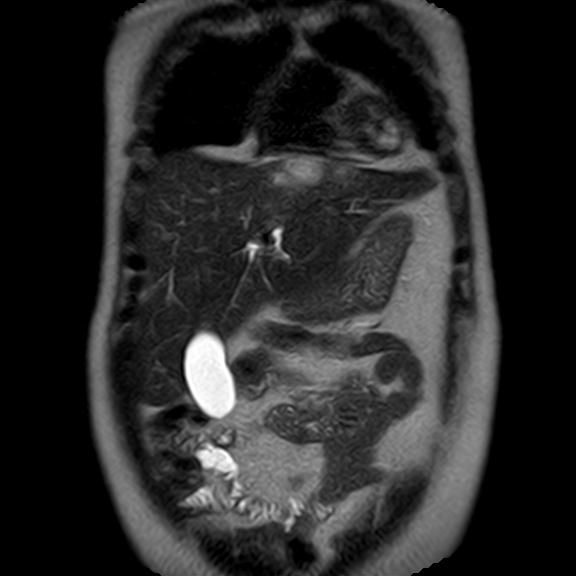File:Ampullary tumor (Radiopaedia 27294-27479 Coronal T2 5).jpg