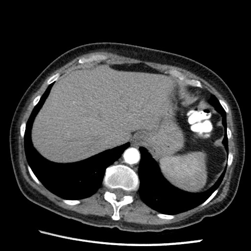 Amyloidosis - bronchial and diffuse nodular pulmonary involvement (Radiopaedia 60156-67745 A 47).jpg