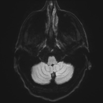 Amyotrophic lateral sclerosis (Radiopaedia 87352-103658 Axial DWI 31).jpg