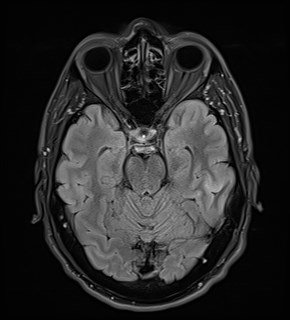File:Amyotrophic lateral sclerosis (Radiopaedia 87352-103658 Axial FLAIR 10).jpg