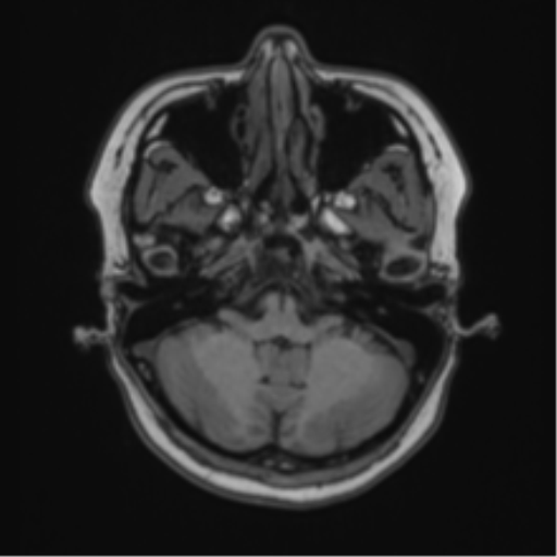 Anaplastic astroblastoma (Radiopaedia 55666-62194 Axial T1 16).png