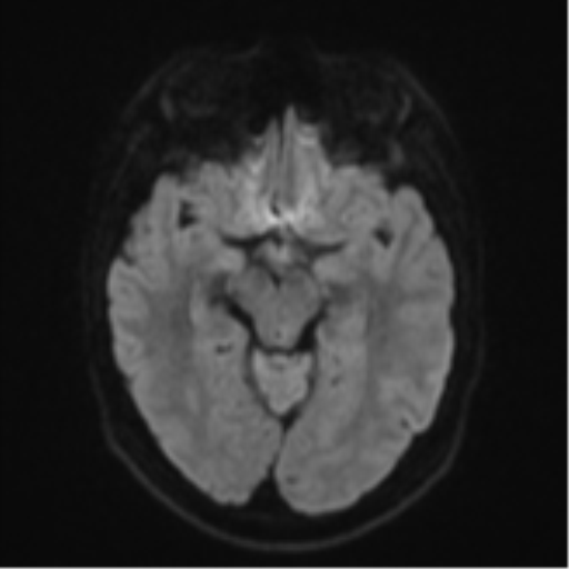 File:Anaplastic astrocytoma (Radiopaedia 57768-64731 Axial DWI 39).png