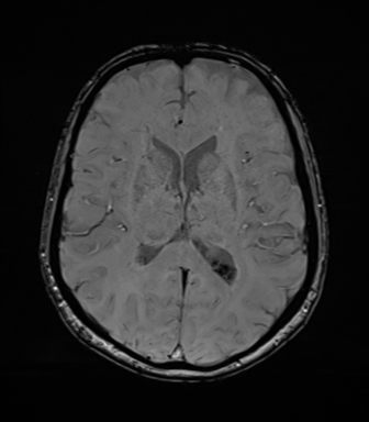 File:Anaplastic astrocytoma (Radiopaedia 86943-103160 Axial SWI 51).png