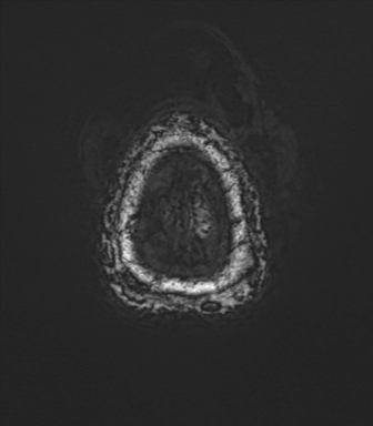 Anaplastic astrocytoma - thalamic glioma (Radiopaedia 59709-67115 G 87).png