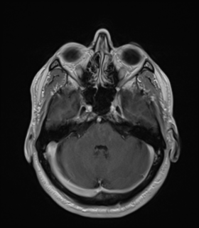 Anaplastic astrocytoma IDH wild-type (Radiopaedia 49984-55273 Axial T1 C+ 17).png