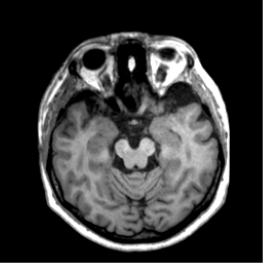 Anaplastic astrocytoma IDH wild-type (pseudoprogression) (Radiopaedia 42209-45277 Axial T1 50).png