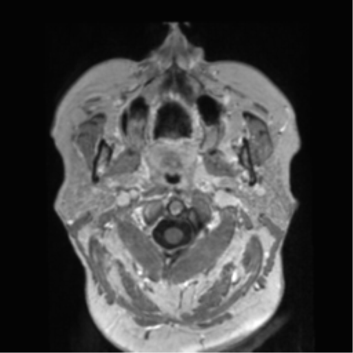 Anaplastic astrocytoma IDH wild-type (pseudoprogression) (Radiopaedia 42209-45278 Axial T1 C+ 9).png
