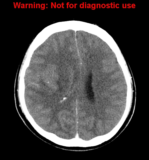 File:Anaplastic ganglioglioma (Radiopaedia 44921-48815 B 19).jpg