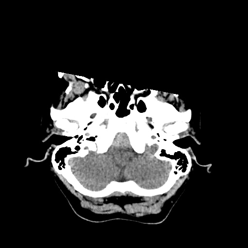 Aneursym related subarachnoid hemorrhage with hydrocephalus (Radiopaedia 45105-49083 Axial non-contrast 4).jpg
