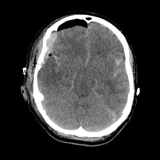 Aneursym related subarachnoid hemorrhage with hydrocephalus (Radiopaedia 45105-49085 Axial non-contrast 18).jpg