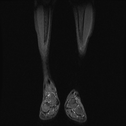 File:Aneurysmal bone cyst - tibia (Radiopaedia 22343-22367 Coronal STIR 4).jpg