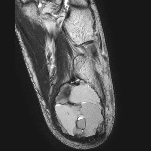 File:Aneurysmal bone cyst of the calcaneus (Radiopaedia 60669-68420 Axial T2 7).jpg