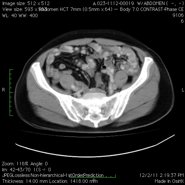 File:Angiodysplasia of the small bowel (Radiopaedia 16387-16075 B 1).jpg