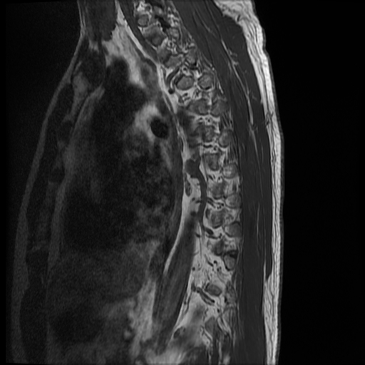 File:Angiolipoma - thoracic spine (Radiopaedia 28242-28479 Sagittal T1 2).jpg