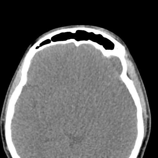 Angular dermoid cyst (Radiopaedia 88967-105790 Axial non-contrast 39).jpg