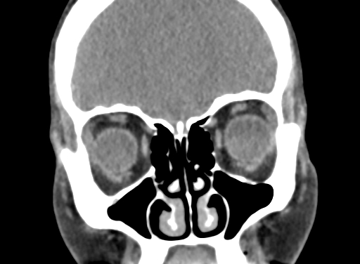 Angular dermoid cyst (Radiopaedia 88967-105790 Coronal non-contrast 25).jpg