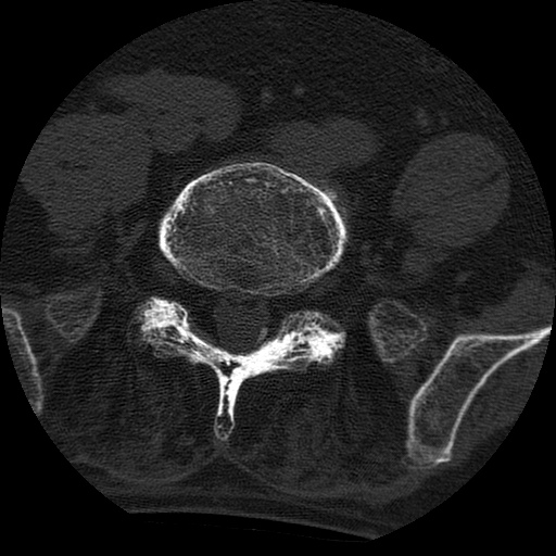 Ankylosing spondylitis complicated by fracture-dislocation (Radiopaedia 33583-34674 Axial non-contrast 134).jpg