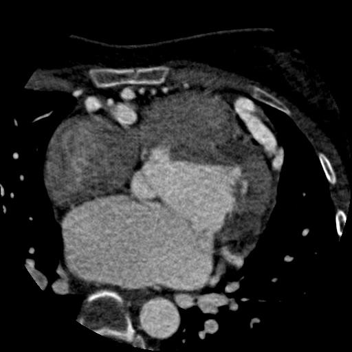 File:Anomalous left coronary artery from the pulmonary artery (ALCAPA) (Radiopaedia 40884-43586 A 34).jpg