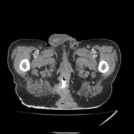 Anorectal carcinoma (Radiopaedia 44413-48064 A 62).jpg