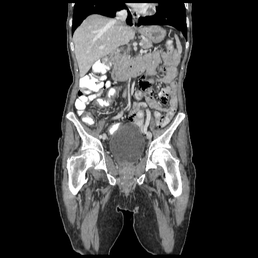 Anorectal carcinoma (Radiopaedia 44413-48064 B 37).jpg