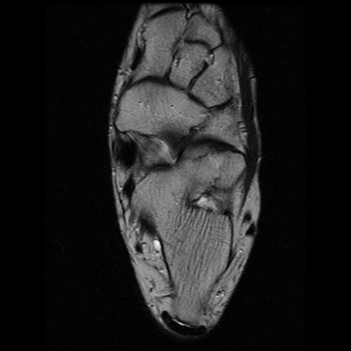 File:Anterior calcaneal process fracture (Radiopaedia 74654-85611 Axial T2 17).jpg