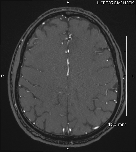 Anterior cerebral artery aneurysm (Radiopaedia 80683-94127 Axial MRA 179).jpg