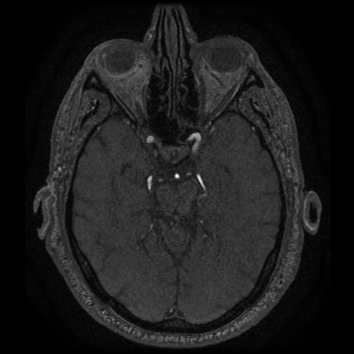 Anterior cerebral artery infarction (Radiopaedia 46794-51323 Axial MRA 67).jpg