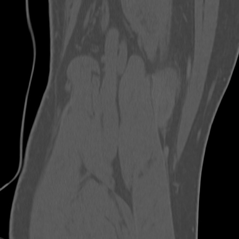 File:Anterior cruciate ligament avulsion fracture (Radiopaedia 58939-66194 Coronal bone window 32).jpg