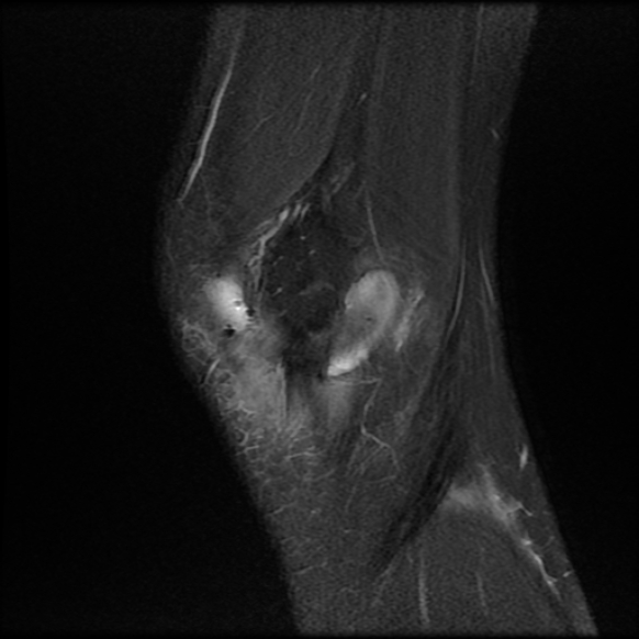 File:Anterior cruciate ligament graft tear and bucket-handle tear of medial meniscus (Radiopaedia 75867-87255 Sagittal PD fat sat 3).jpg