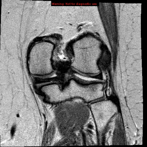 File:Anterior cruciate ligament tear (Radiopaedia 12329-12612 Coronal PD 16).jpg