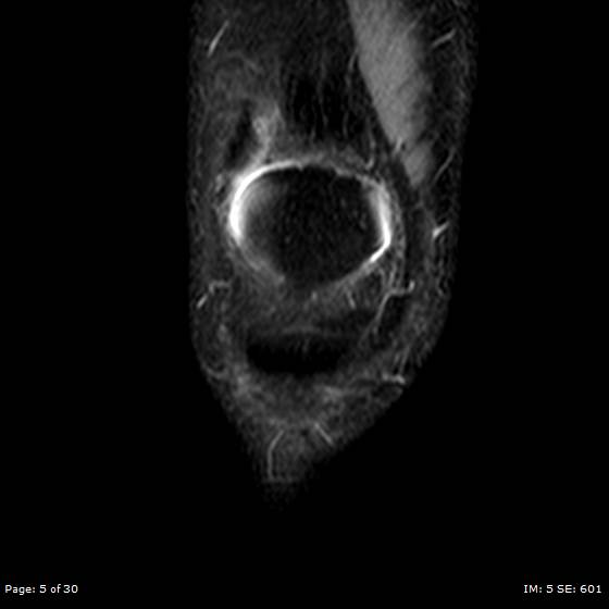 File:Anterior cruciate ligament tear (Radiopaedia 70783-80964 Coronal STIR 5).jpg