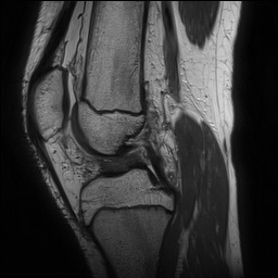 Anterior cruciate ligament tear - pediatric (Radiopaedia 62152-70260 Sagittal PD 85).jpg