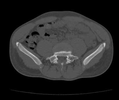 File:Anterior inferior iliac spine avulsion fracture (Radiopaedia 81312-94999 Axial bone window 17).jpg