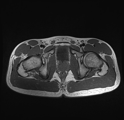 File:Anterior inferior iliac spine avulsion fracture (Radiopaedia 81312-95000 Axial T1 12).jpg