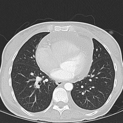 Anterior mediastinal lymphoma (Radiopaedia 29556-30061 Axial lung window 36).jpg