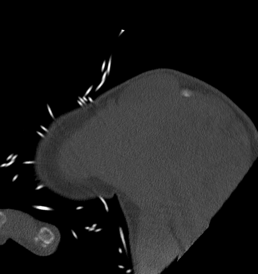 Anterior shoulder dislocation with Hill-Sachs and bony Bankart lesions (Radiopaedia 40424-42974 Sagittal bone window 11).png