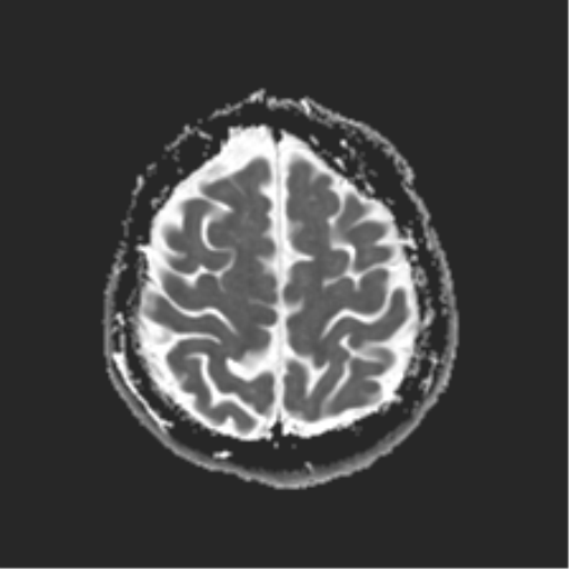File:Anterior temporal lobe perivascular space (Radiopaedia 40946-43650 Axial ADC 23).png