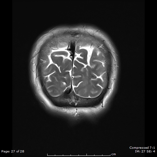 File:Anterior temporal lobe perivascular space (Radiopaedia 88283-104914 Coronal T2 27).jpg