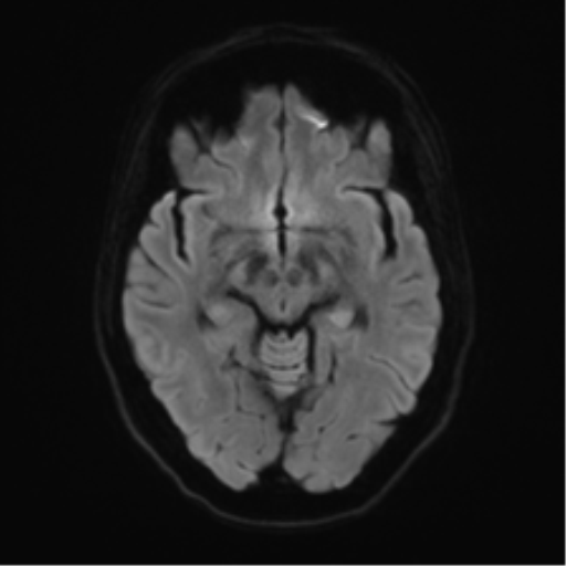 Anterior temporal pole cysts (Radiopaedia 46629-51102 Axial DWI 39).png