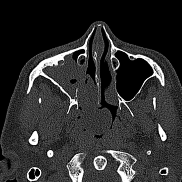 Antrochoanal polyp (Radiopaedia 30002-30554 Axial bone window 24).jpg