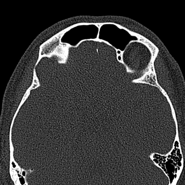 Antrochoanal polyp (Radiopaedia 30002-30554 Axial bone window 48).jpg