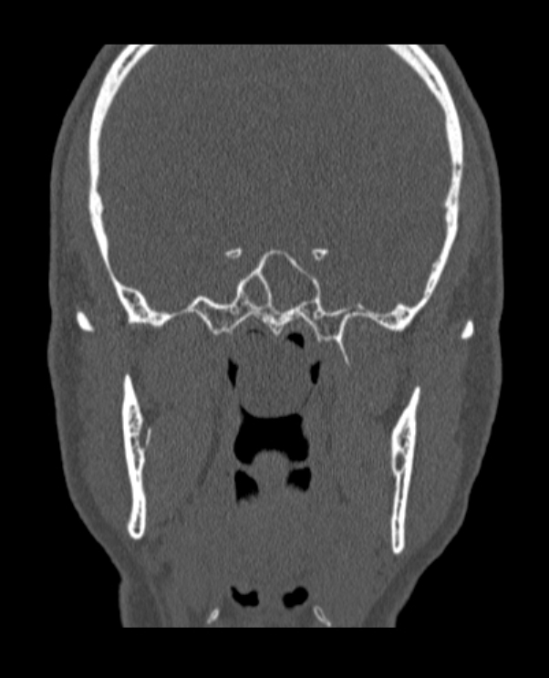 Antrochoanal polyp (Radiopaedia 79011-92169 Coronal bone window 17).jpg