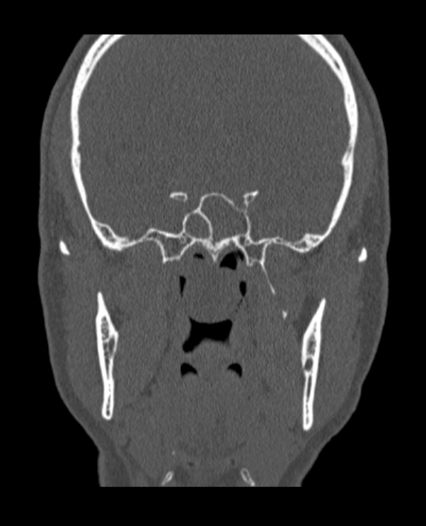 Antrochoanal polyp (Radiopaedia 79011-92169 Coronal bone window 19).jpg